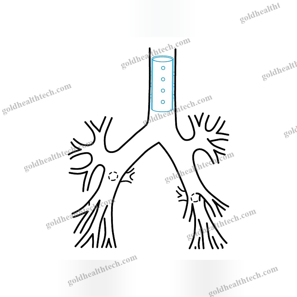 Tracheal Stent