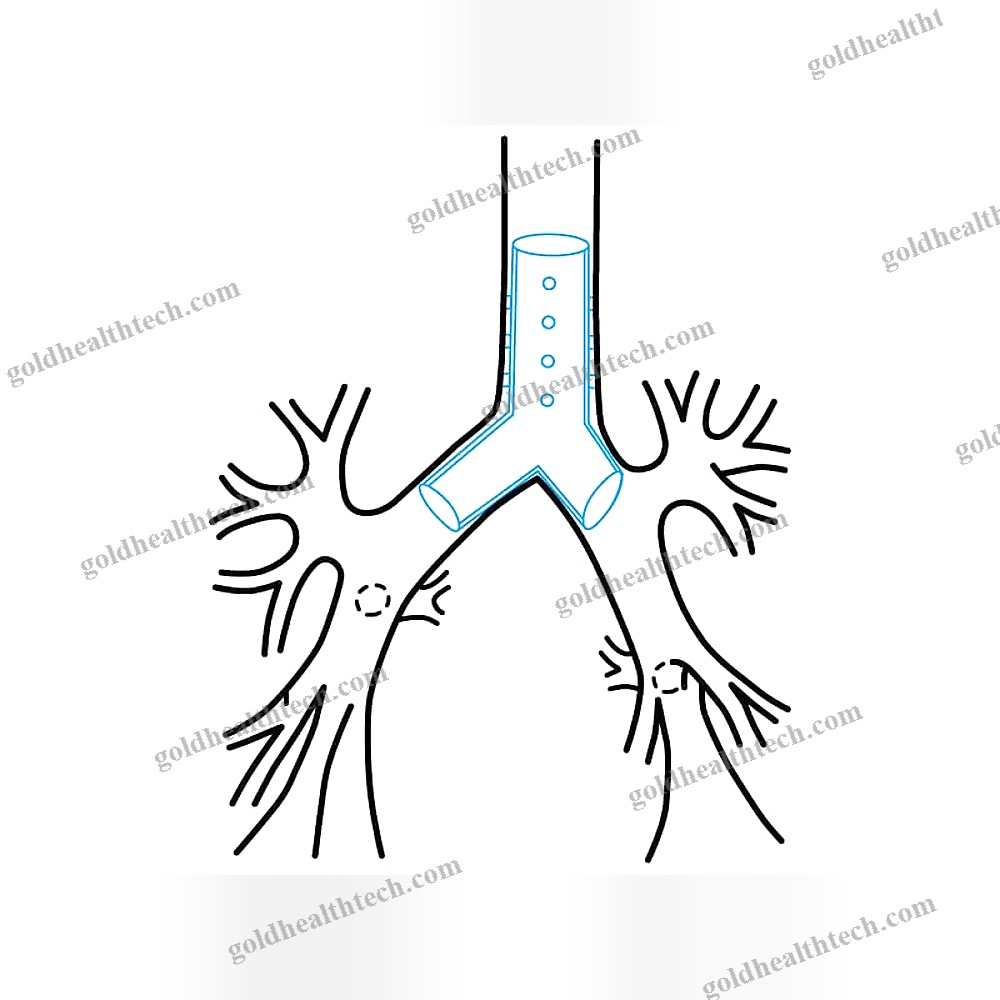 Esophageal Stent