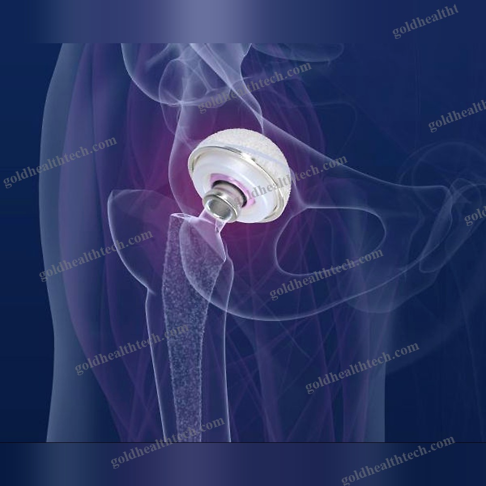 Revision Hip Prosthesis