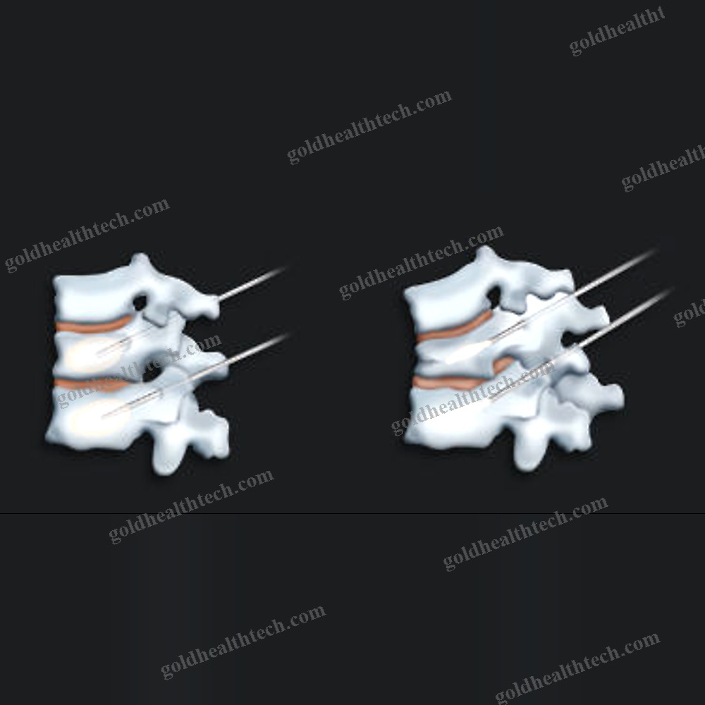 Balloon Catheter Spine Augmentation System