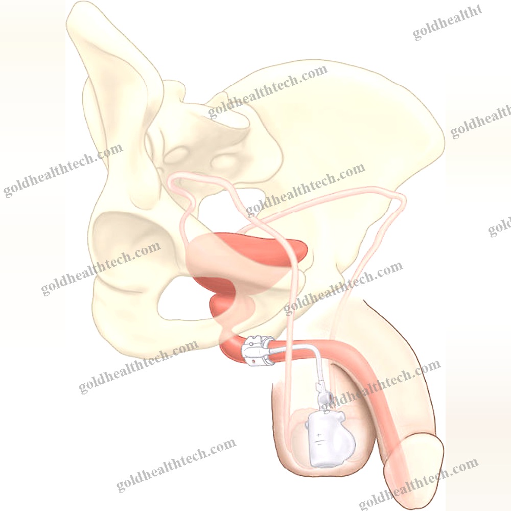 Vesical Sphincter Prosthesis