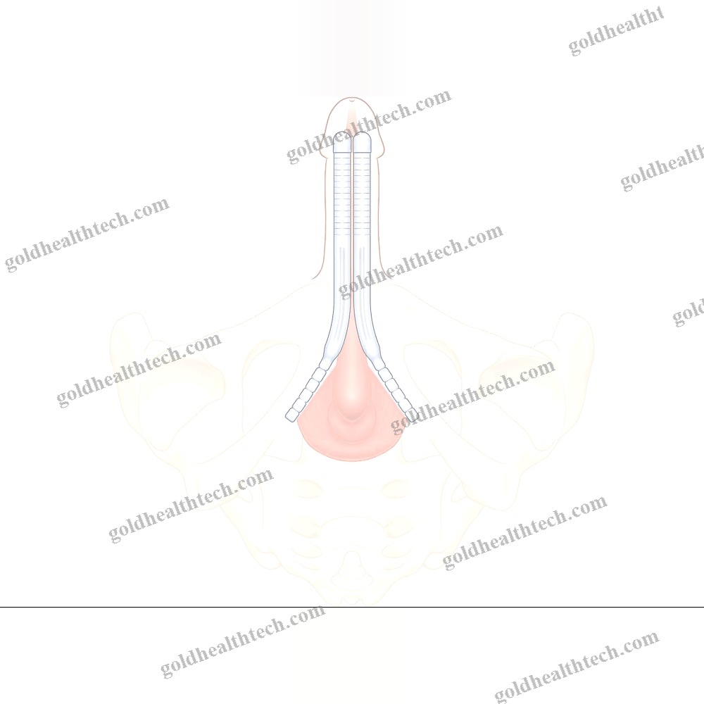 Malleable Penile Prosthesis