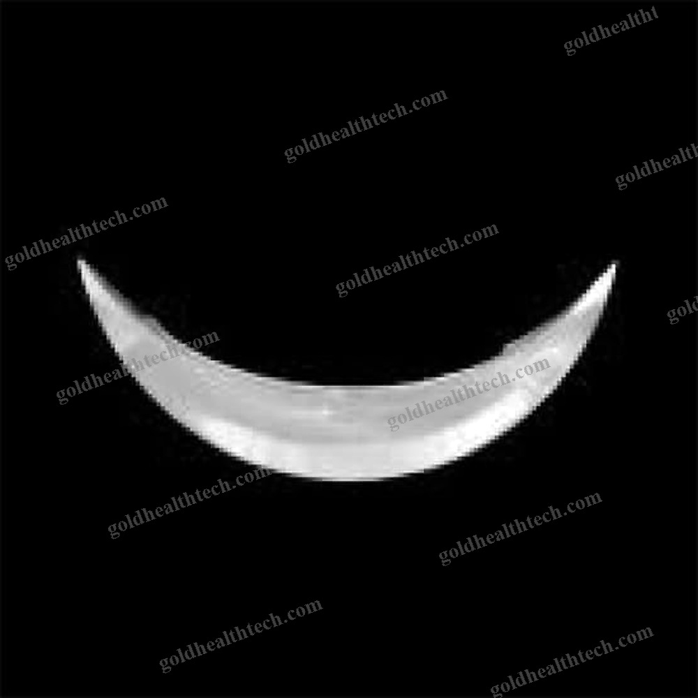 Chin Implant