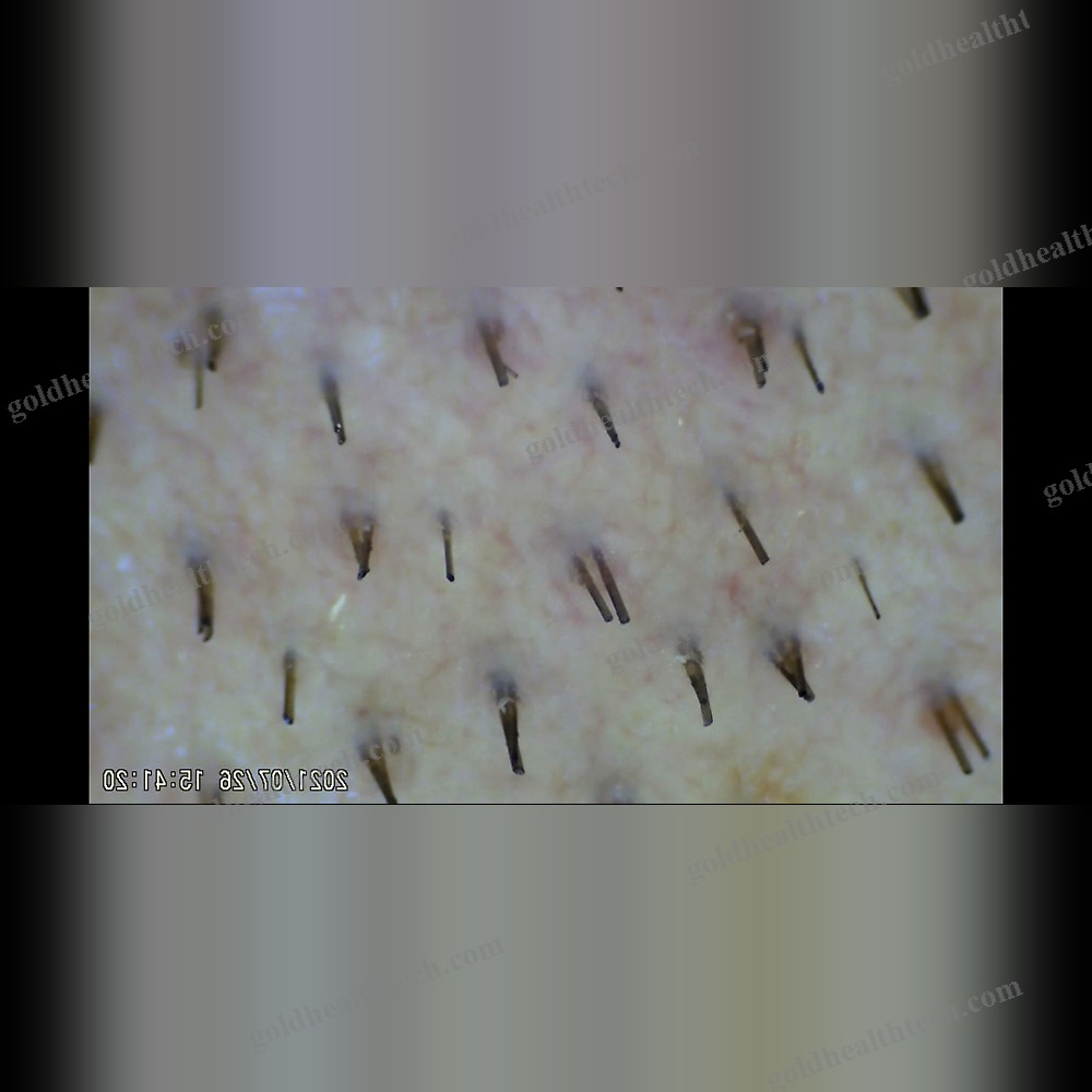 Video Trichoscope