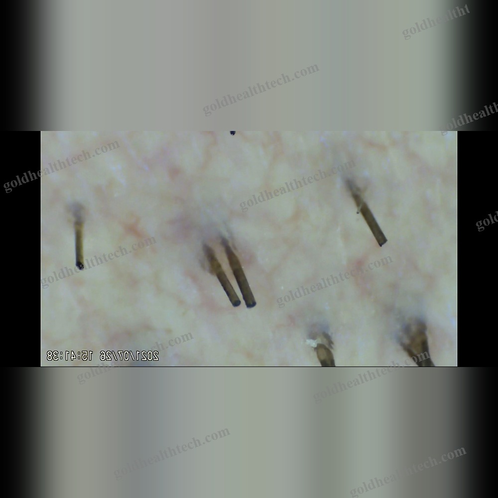 Video Trichoscope