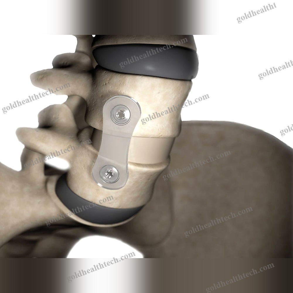 Thoraco-Lumbar Arthrodesis Plate