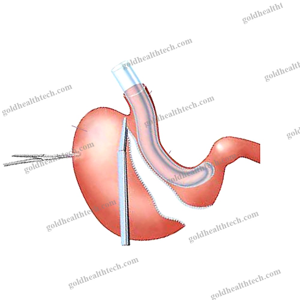 Gastric Bypass Gastric Calibration Tube