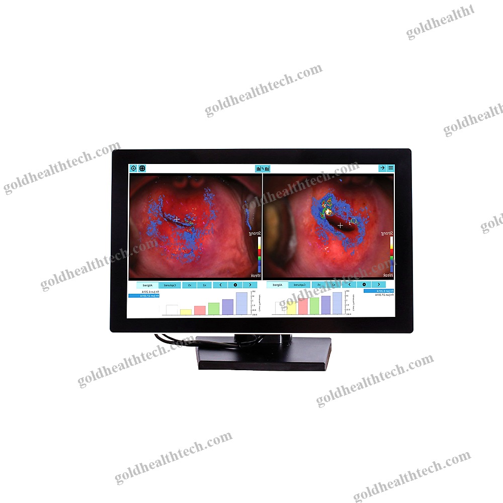 Video Colposcope
