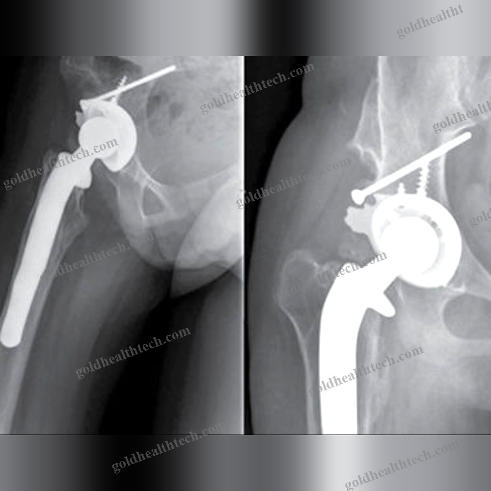 Primary Hip Prosthesis