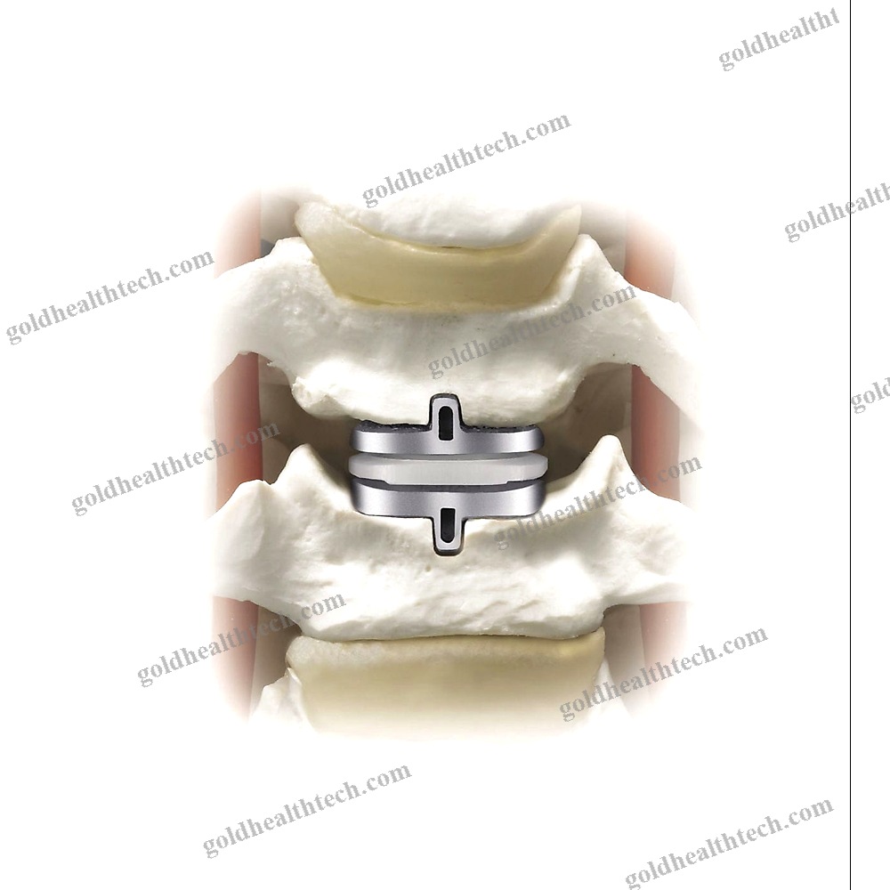 Cervical Disc Prosthesis