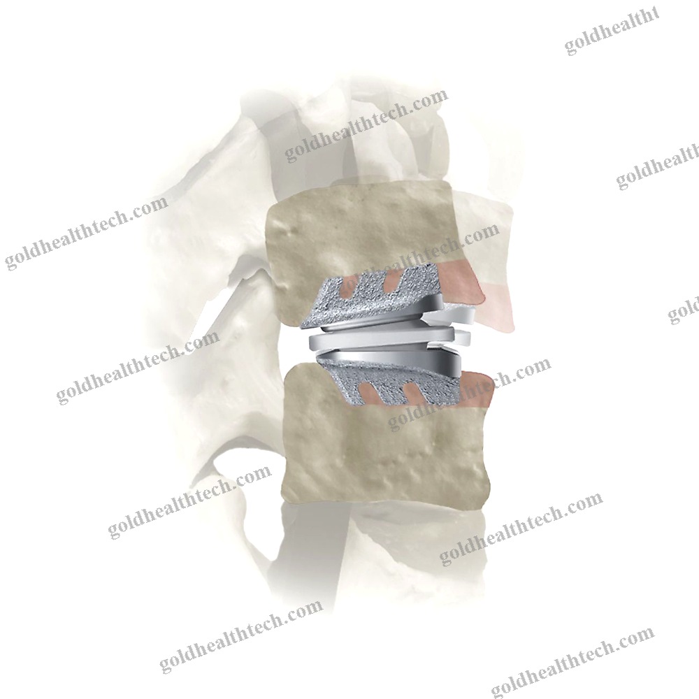 Cervical Disc Prosthesis