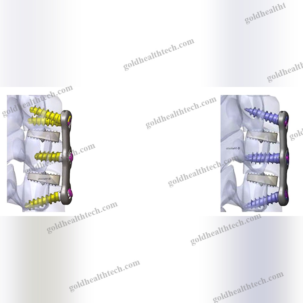 Cervical Arthrodesis Plate