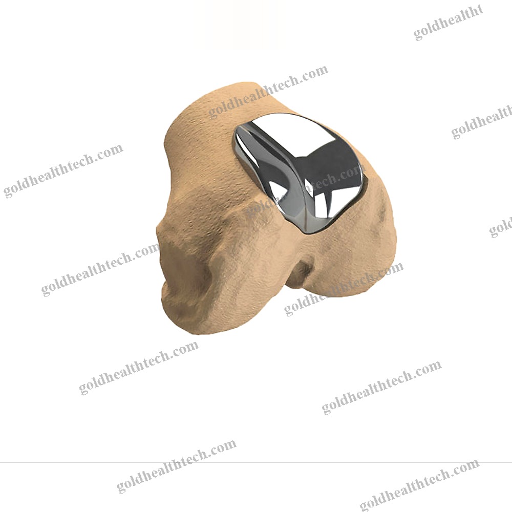 Unicompartmental Patello-Femoral Prosthesis