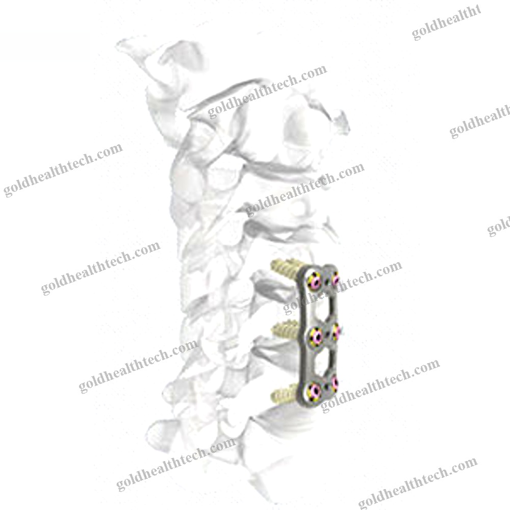 Cervical Arthrodesis Plate