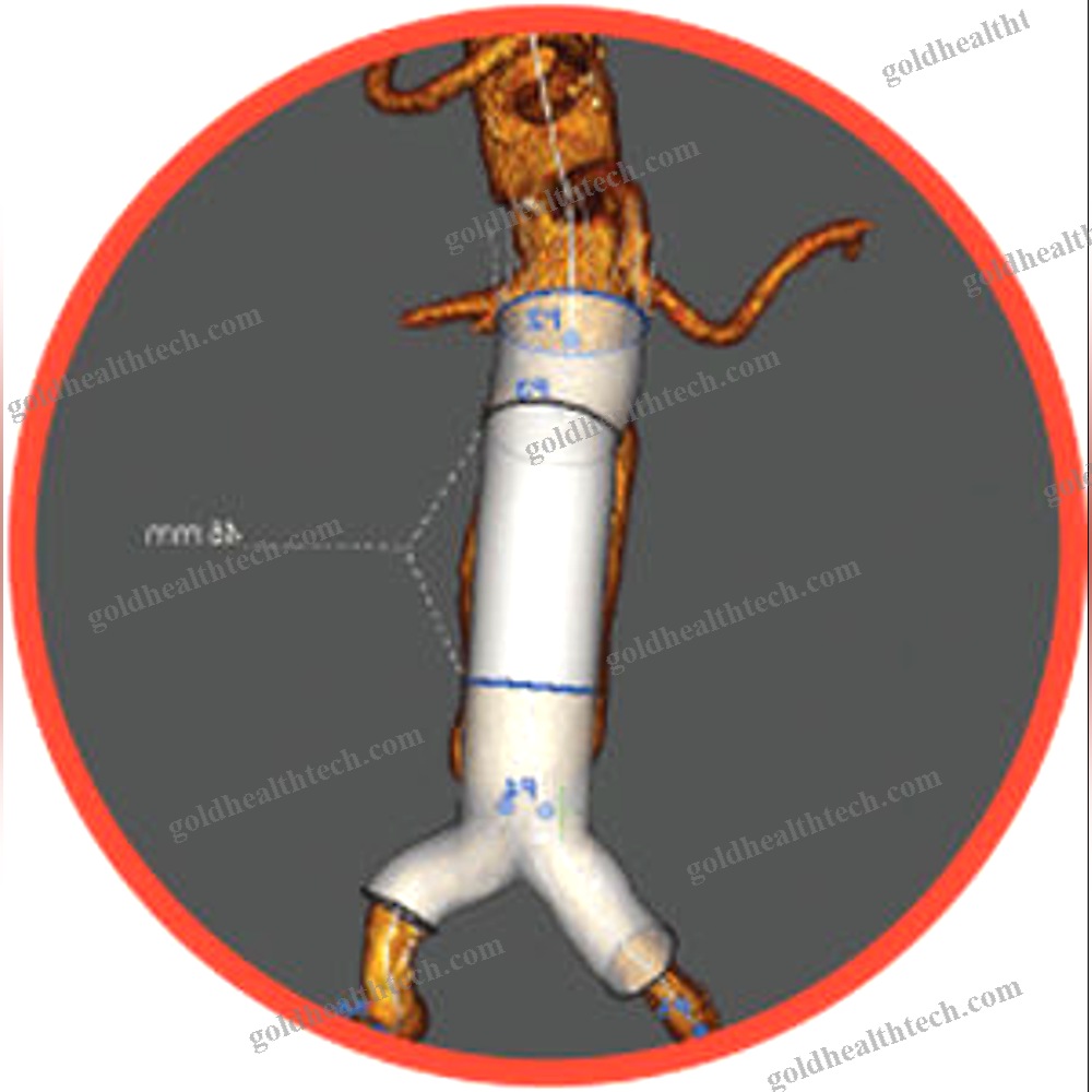 Abdominal Aorta Stent Graft