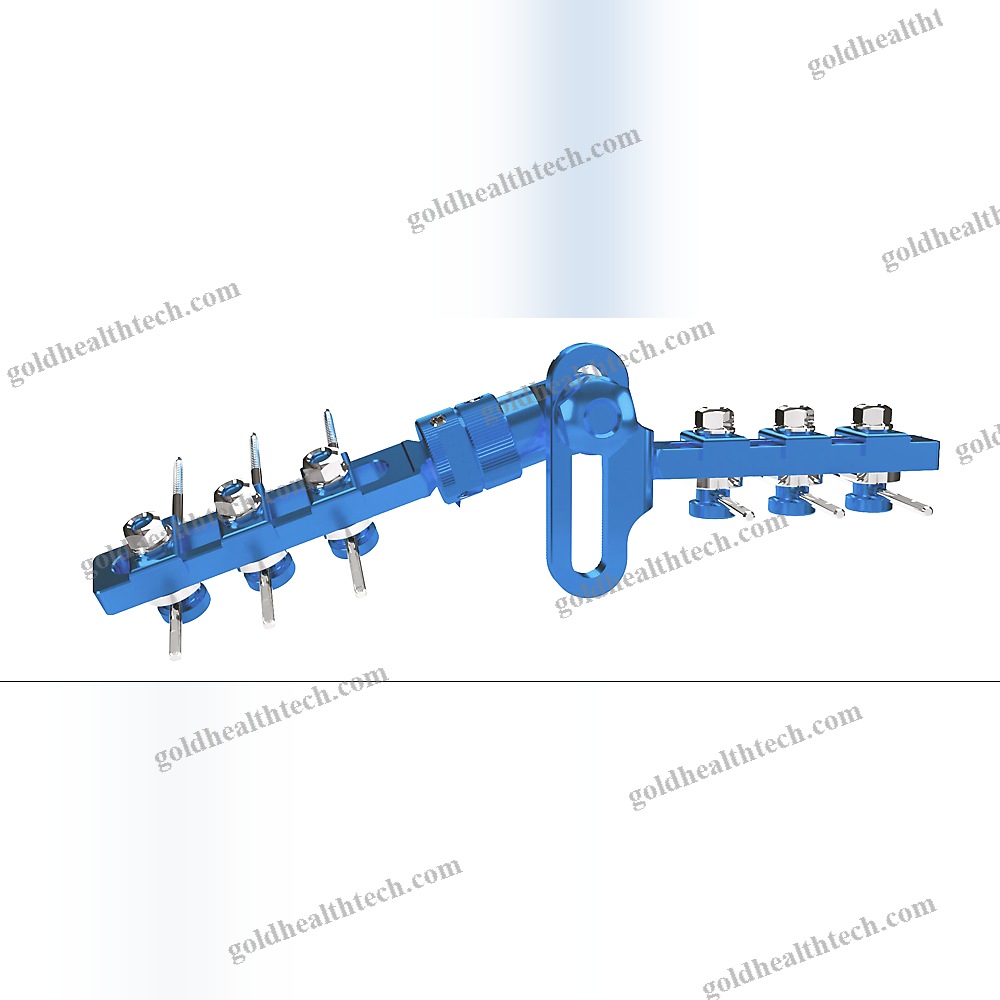 Modular External Fixation System