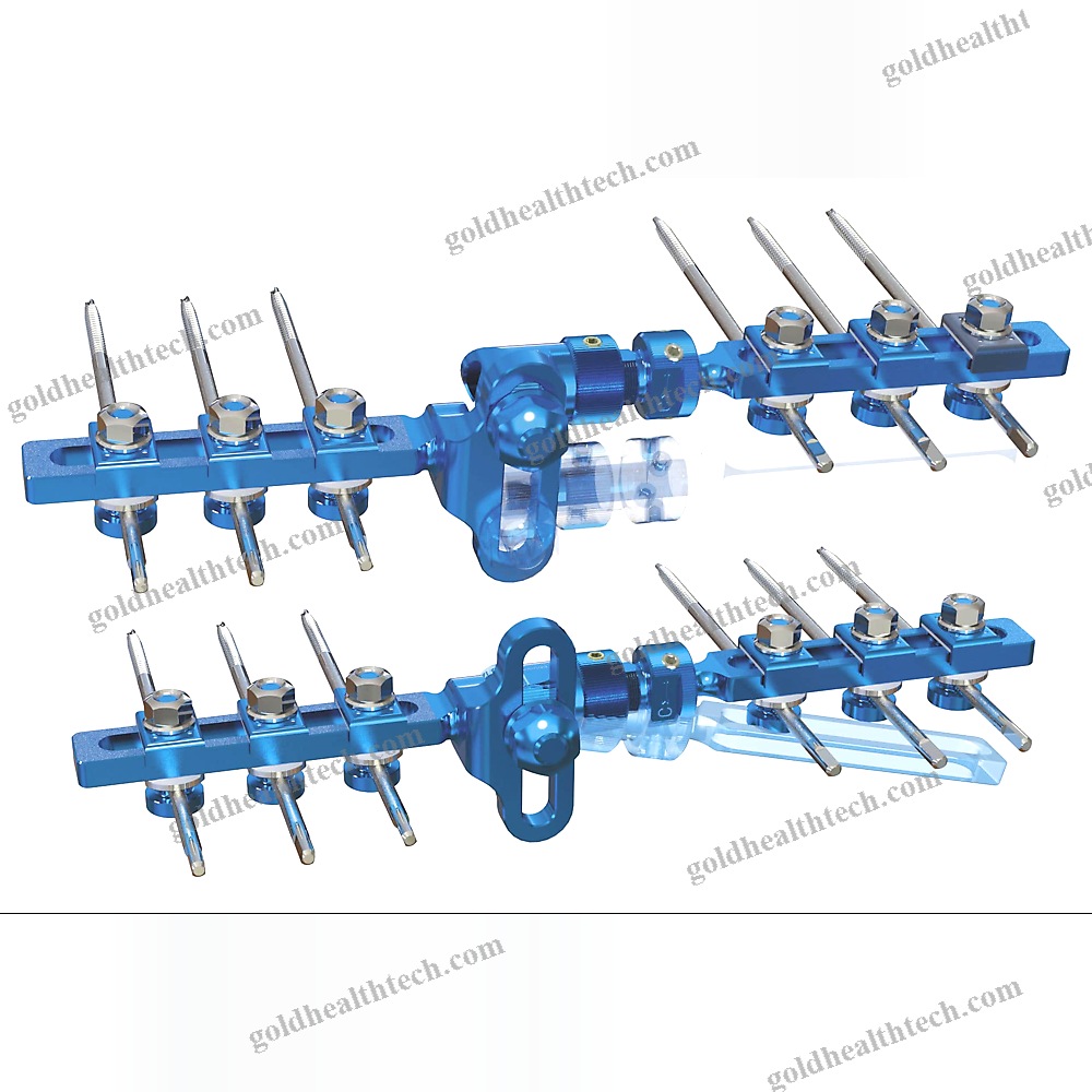 Modular External Fixation System