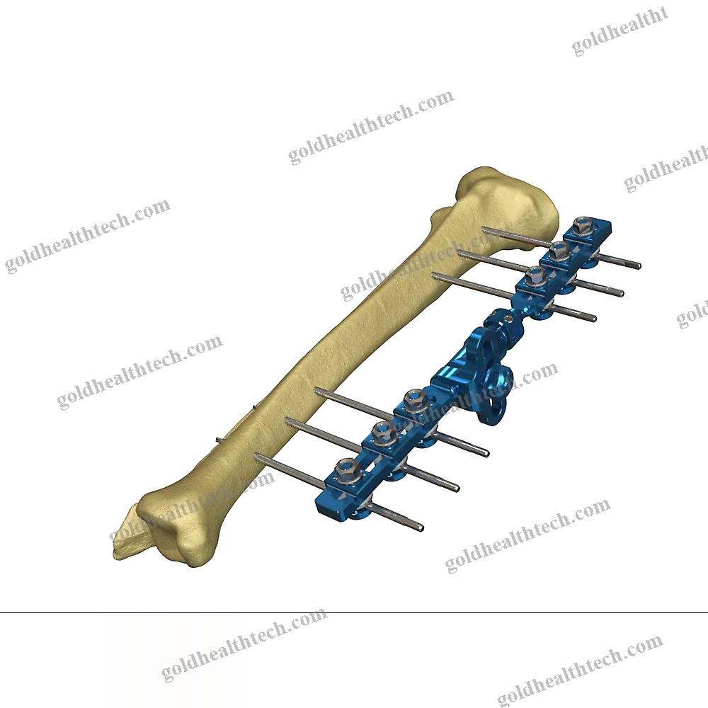 Modular External Fixation System