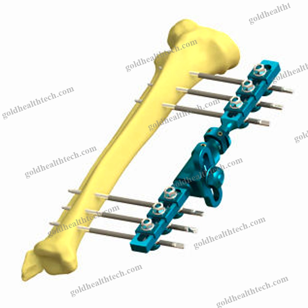 Modular External Fixation System