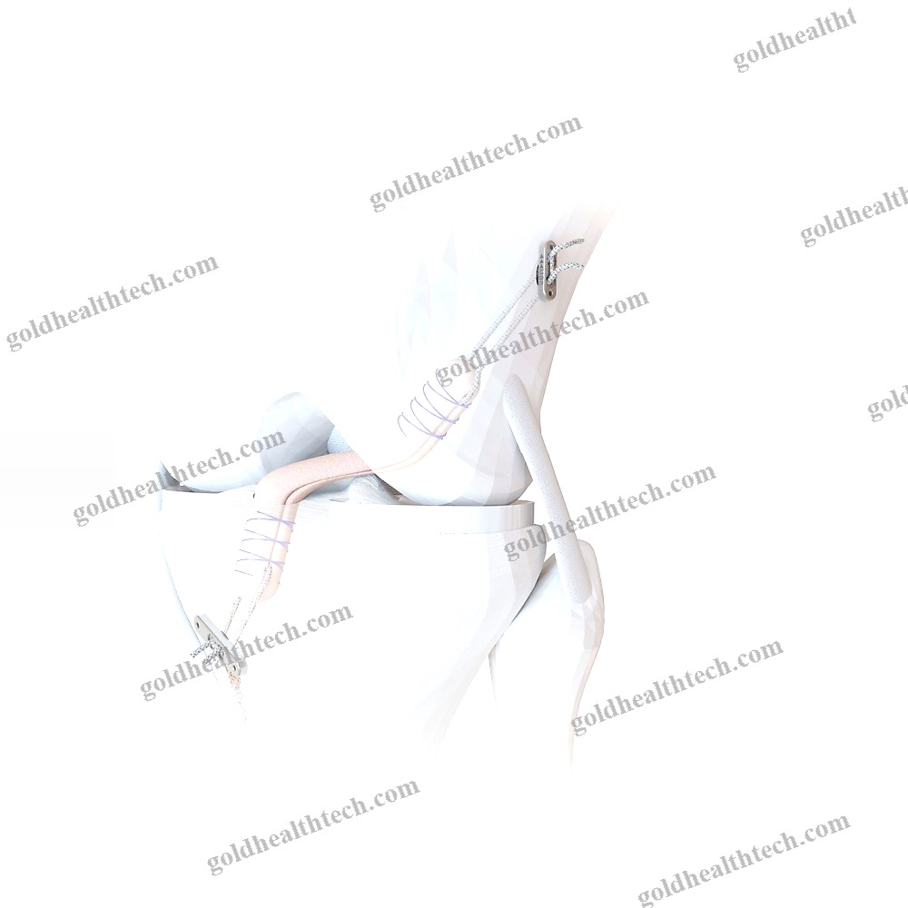 Acl Reconstruction Suture Button