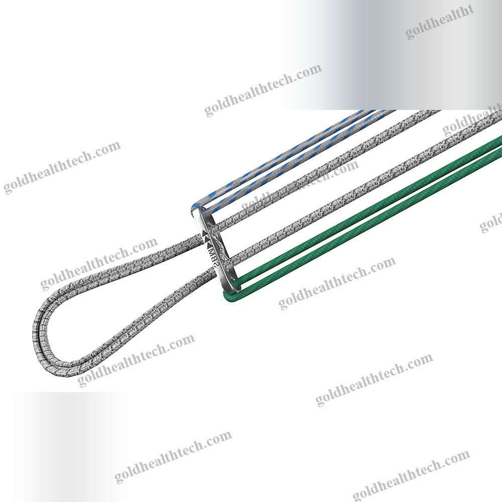 Acl Reconstruction Suture Button