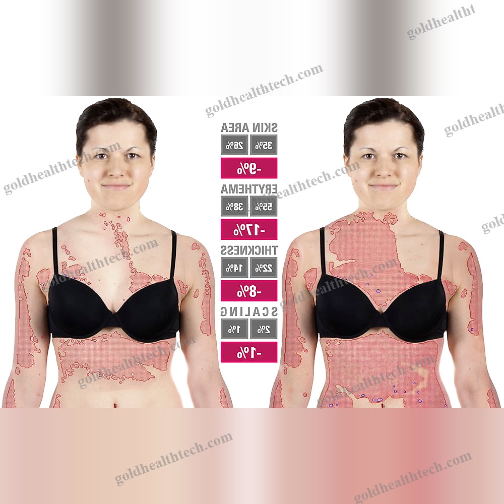 Skin Psoriasis Severity Analysis System