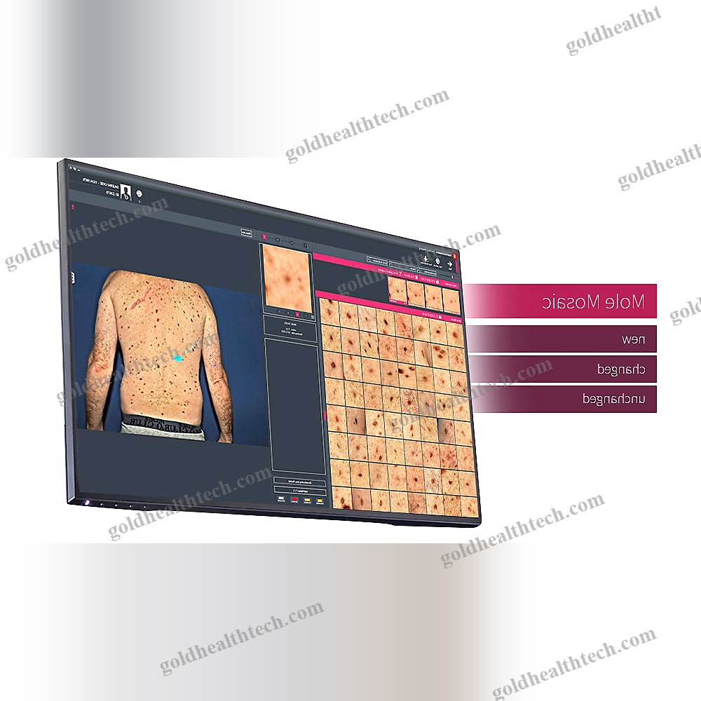 Video Dermatoscope