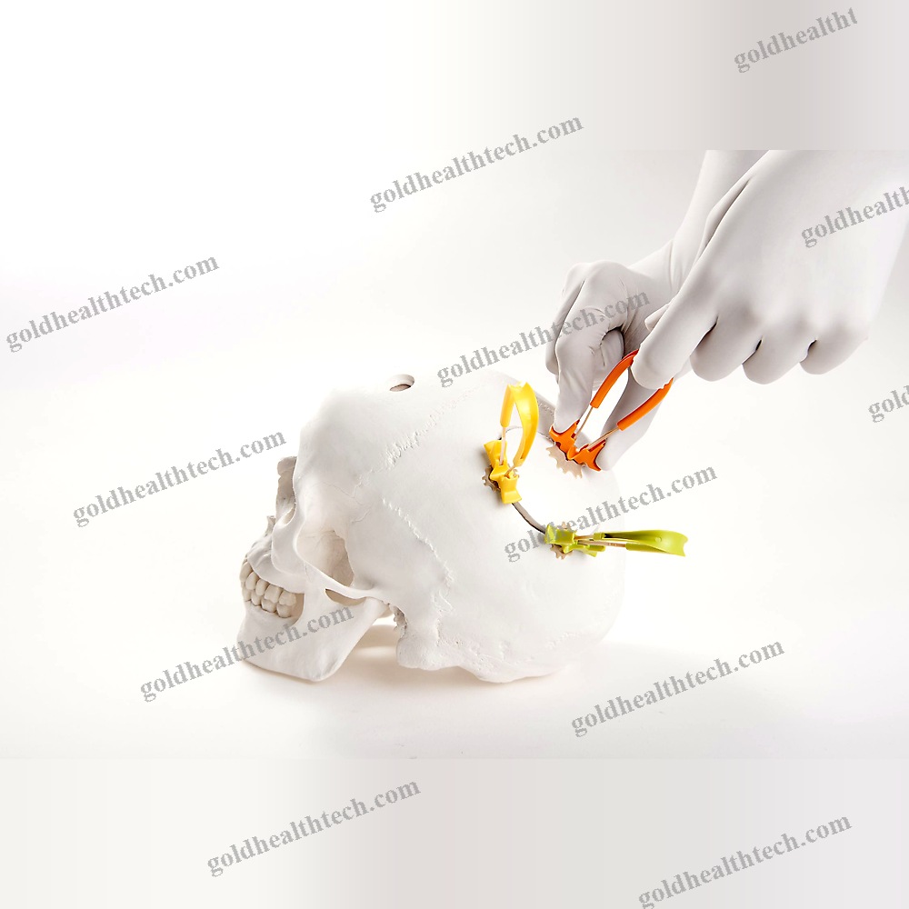 Non-Absorbable Cranial Fixation System