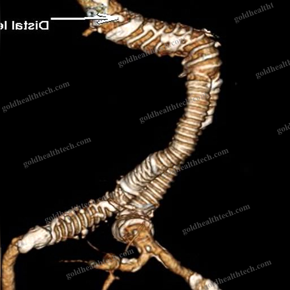 Abdominal Aorta Stent Graft 1