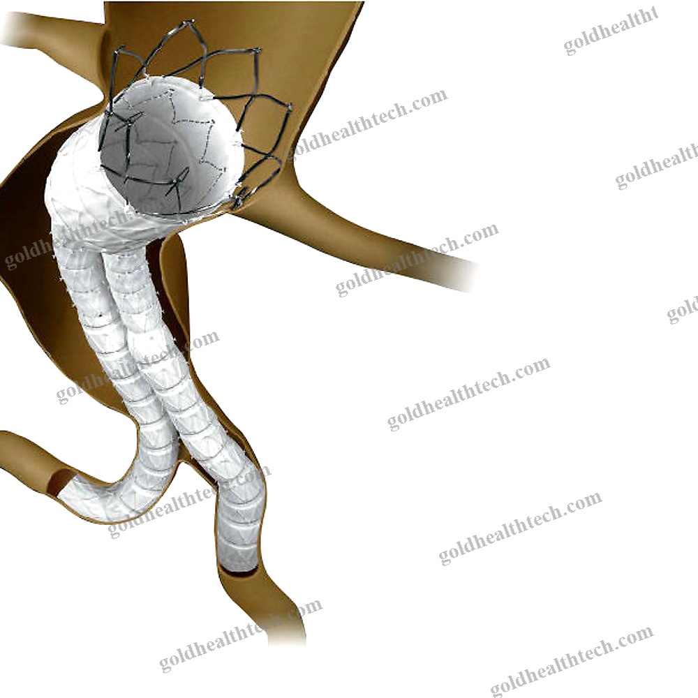 Abdominal Aorta Stent Graft 1