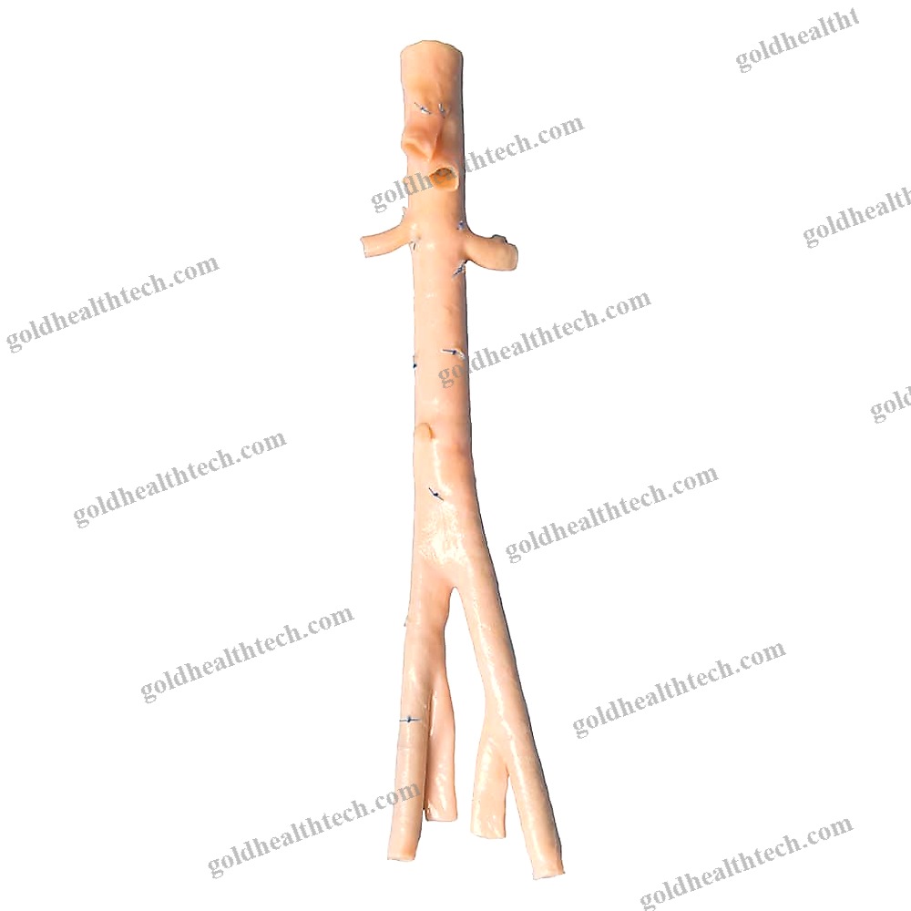 Abdominal Aorta Vascular Bioprosthesis
