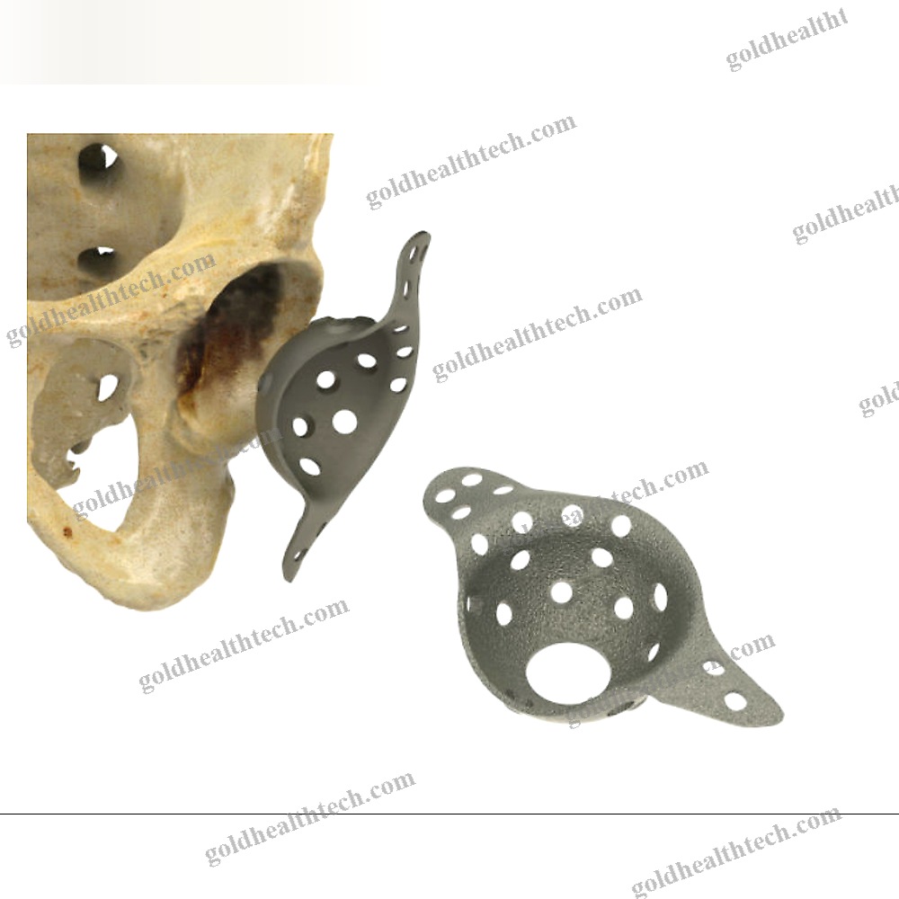 Acetabular Reinforcement