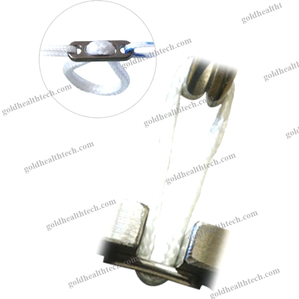 Acl Reconstruction Suture Button