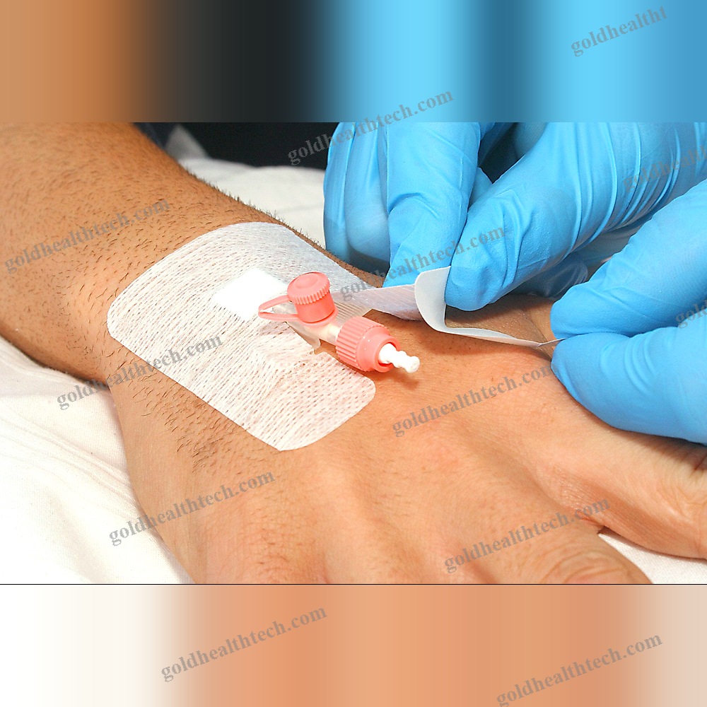 Adhesive Catheter Fixation