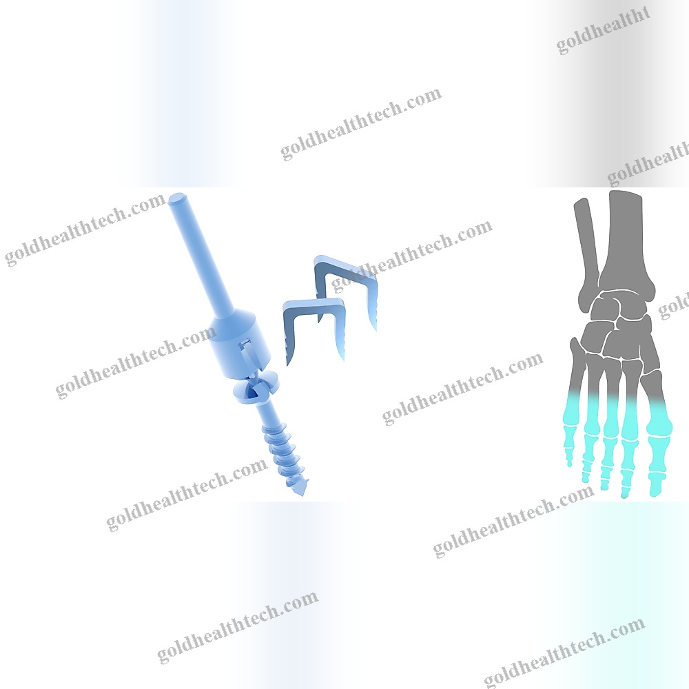 Akin Osteotomy Bone Staple 1