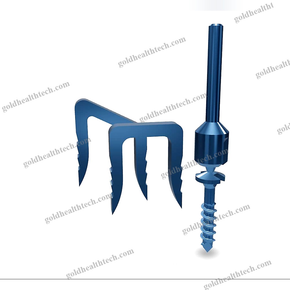 Akin Osteotomy Bone Staple