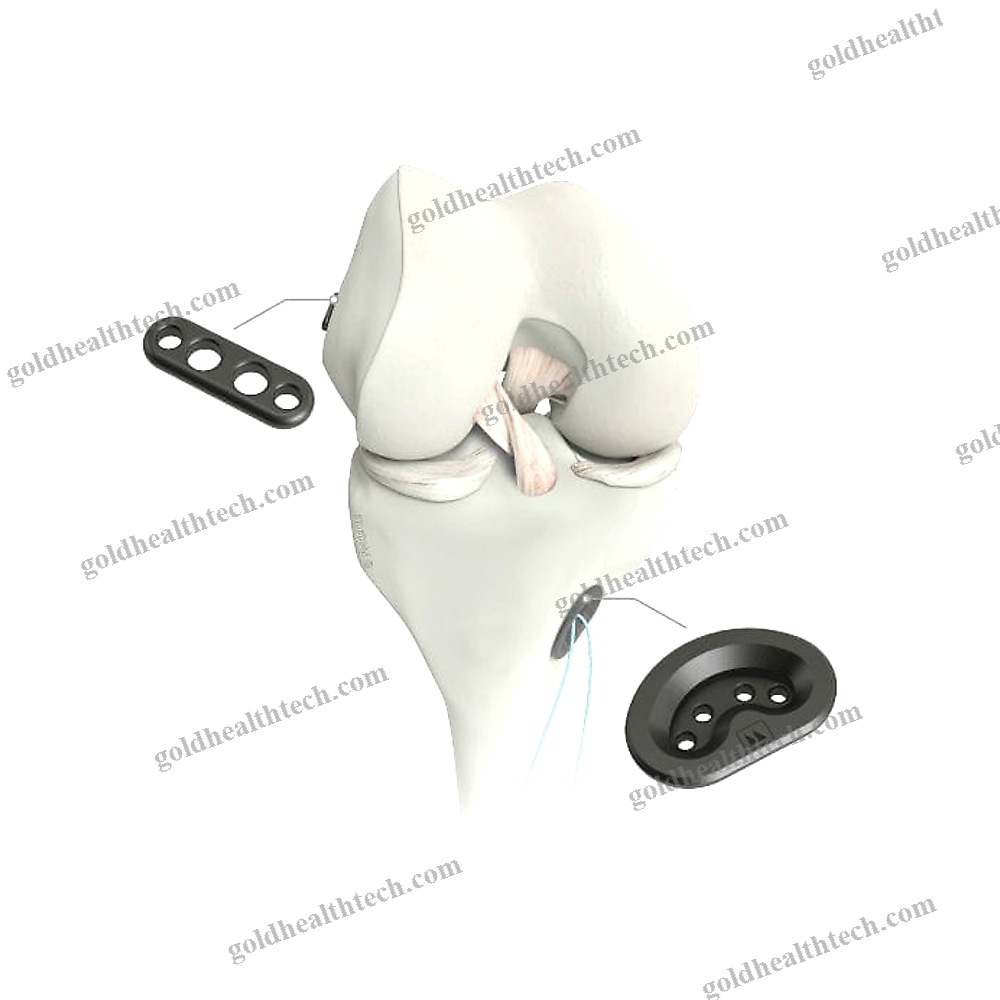 Anterior Cruciate Ligament Ligament Prosthesis