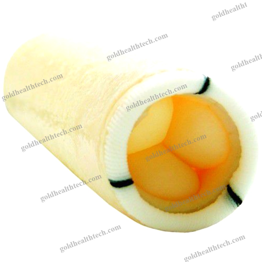 Ascending Aorta Vascular Bioprosthesis