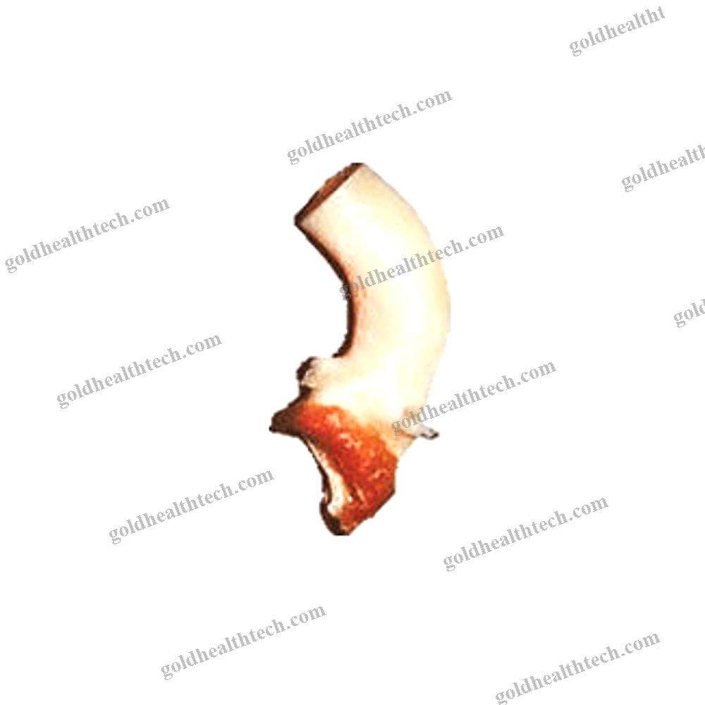 Ascending Aorta Vascular Bioprosthesis
