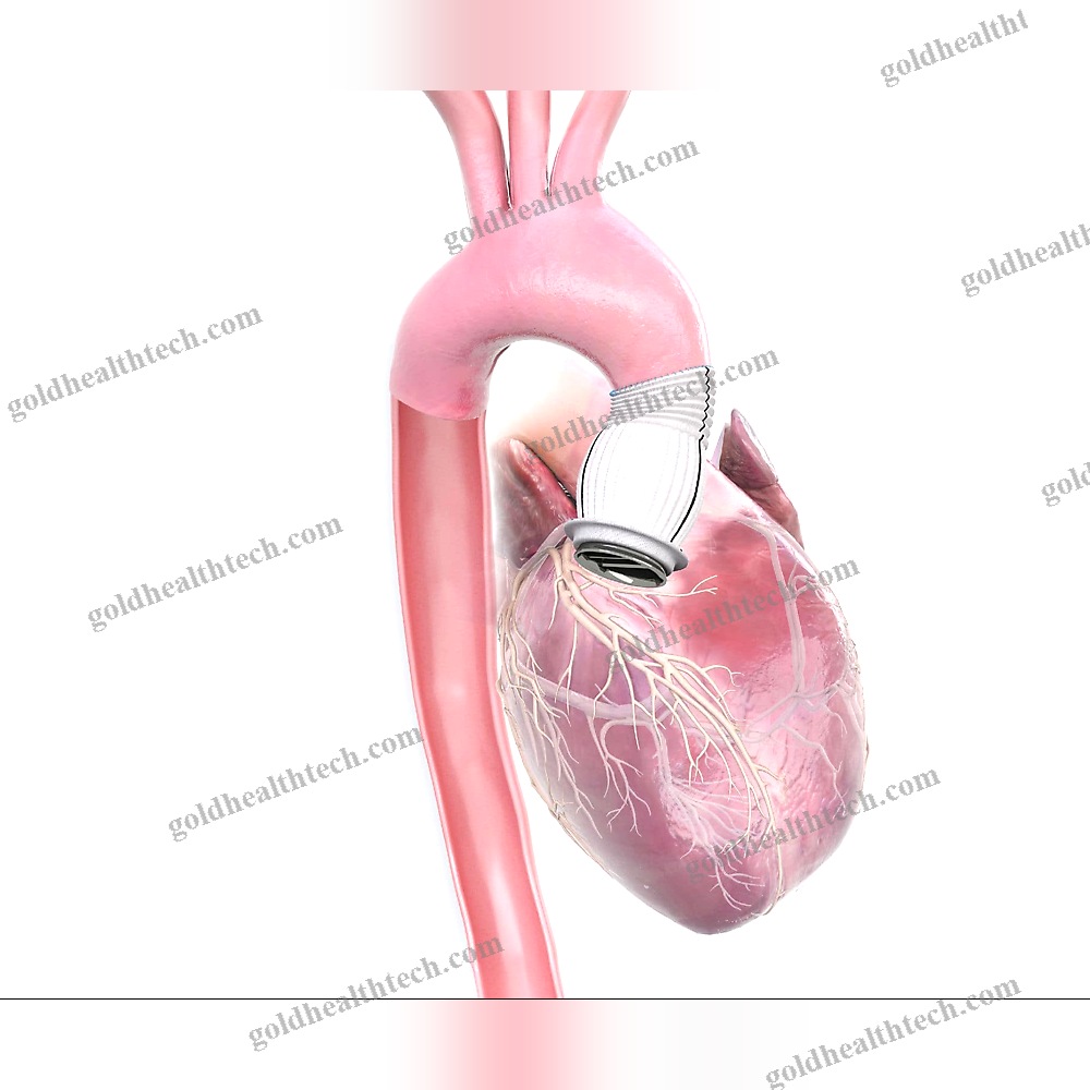 Ascending Aorta Vascular Prosthesis 1