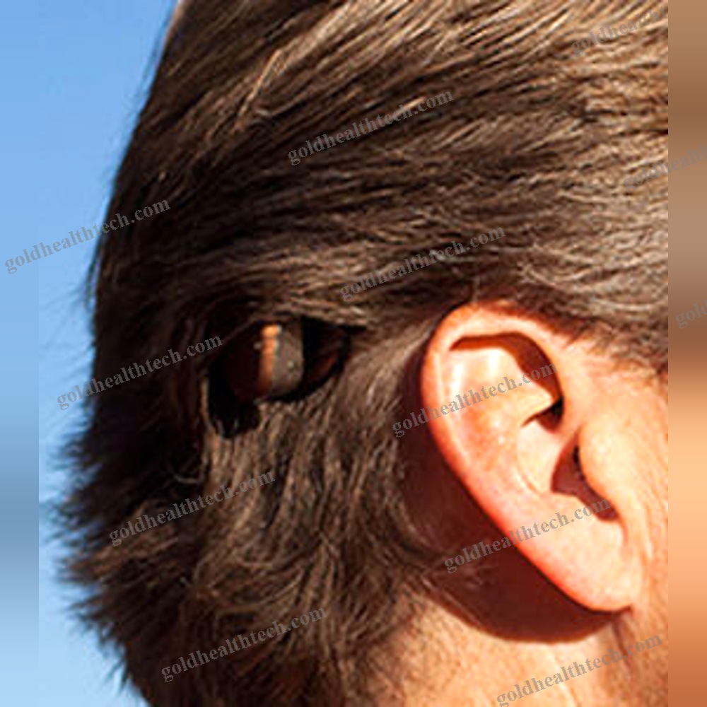Body-Worn Processor Bone Conduction Implant 1