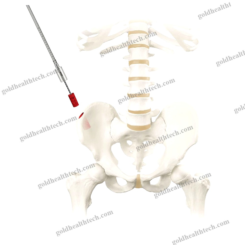 Bone Marrow Biopsy Needle