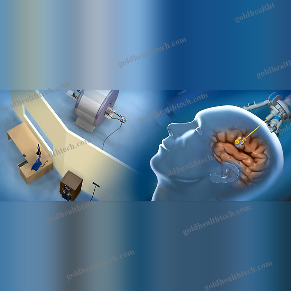 Brain Tumor Treatment Laser Ablation System