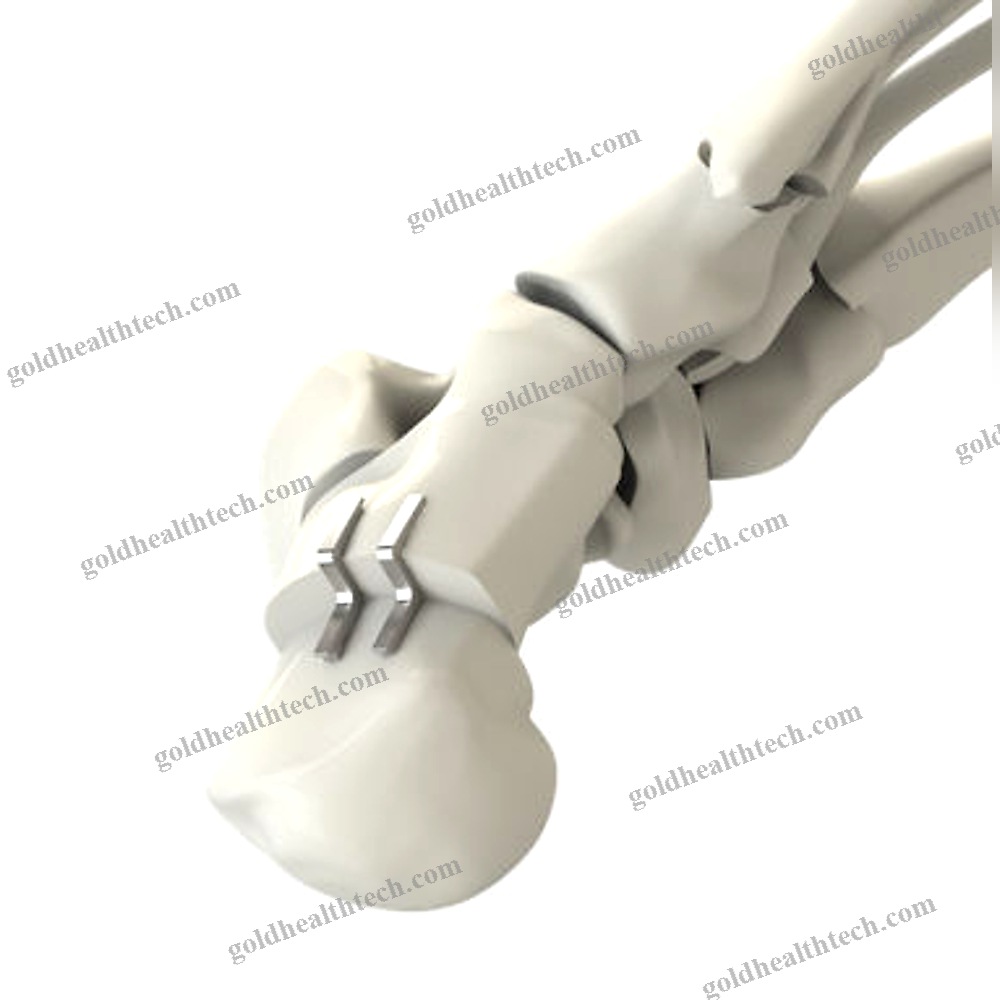 Calcaneal Displacement Osteotomy Bone Staple