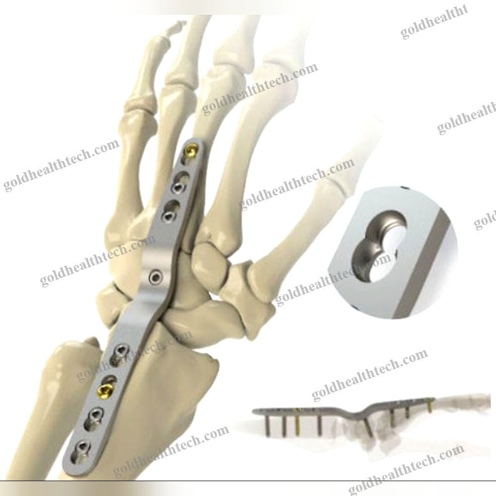 Carpal Joint Arthrodesis Plate