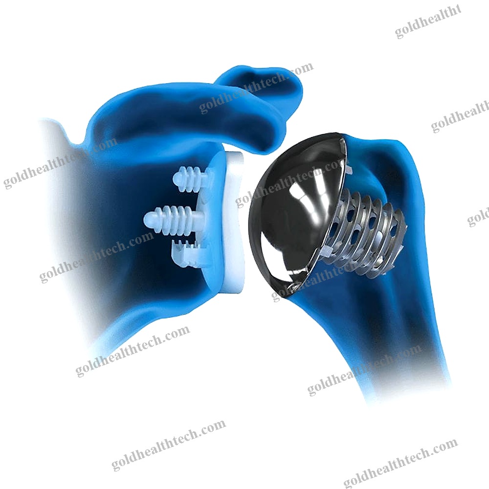 Cemented Or Non-Cemented Shoulder Prosthesis