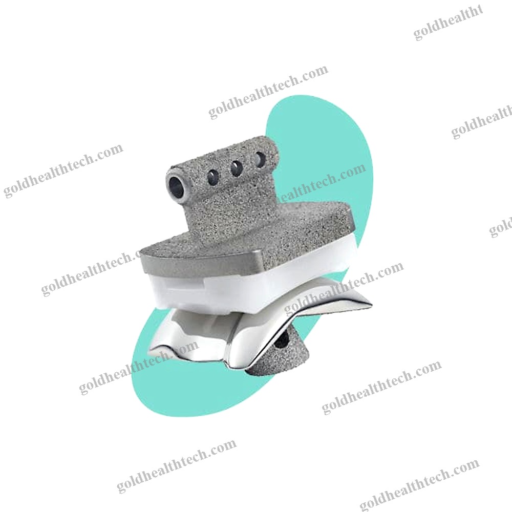 Cementless Total Ankle Prosthesis