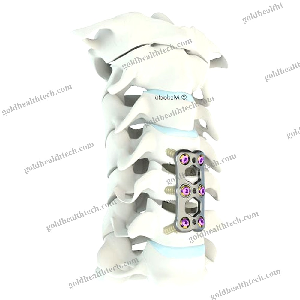 Cervical Arthrodesis Plate