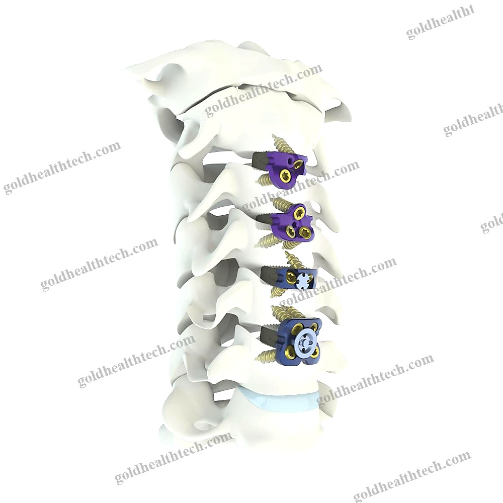Cervical Interbody Fusion Cage