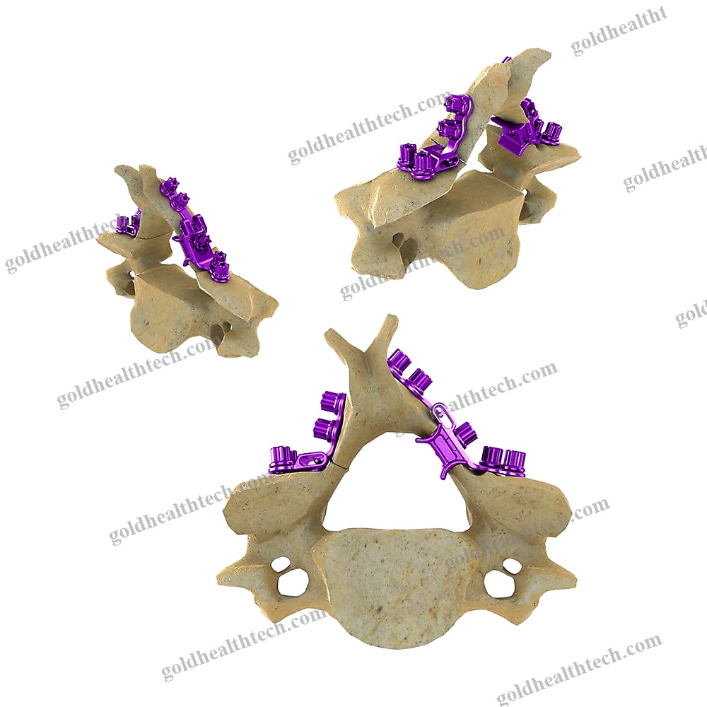 Cervical Vertebra Laminoplasty Plate